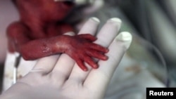 FILE - A nurse holds the hand of a premature baby, who was born at five months of pregnancy, at a hospital in Medellin, Colombia, Aug. 20, 2014.