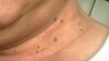 Skin tags