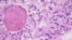 FILE - A high-magnification image from a 2012 glioblastoma case is seen as an example in this College of American Pathologists image released from Northfield, Ill., July 20, 2017. 