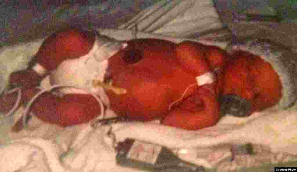 凯西出生就有罕见肠疾（图片由Rachel提供）