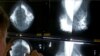FILE - Radiologist uses magnifying glass to check mammograms for breast cancer in Los Angeles.