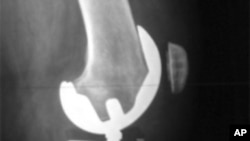 X光照射显示人工的膝关节