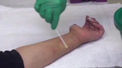 Eczema Treatment During Infancy Helps Prevent Asthma, Allergies